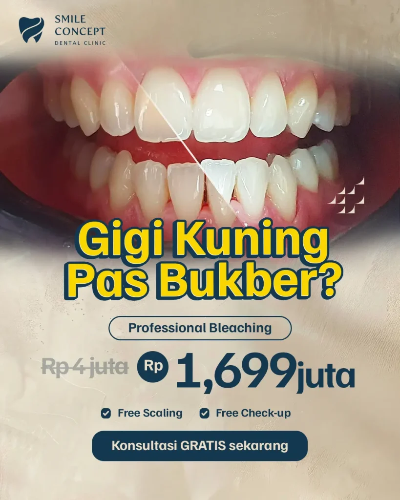 Iklan diskon Professional Bleaching gigi dari Rp4 juta menjadi Rp1,699 juta di SMILE CONCEPT DENTAL CLINIC, dengan bonus scaling dan check-up gratis