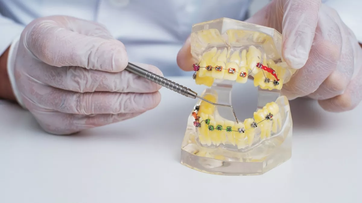 Bingung memilih jenis behel gigi? Kenali perbedaan behel metal, keramik, self-ligating, lingual, dan clear aligner agar bisa memilih perawatan yang sesuai